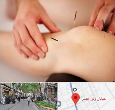 دکتر طب سوزنی برای لاغری در ولیعصر شهریار