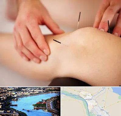 دکتر طب سوزنی برای لاغری در خرمشهر