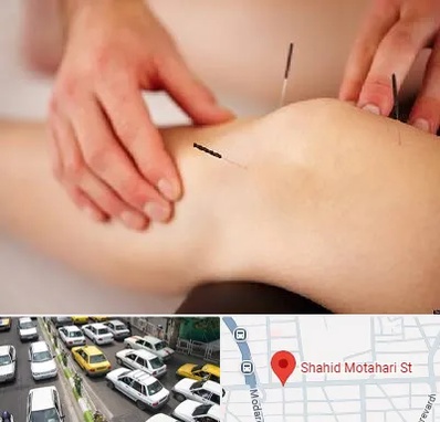 دکتر طب سوزنی برای لاغری در مطهری تهران