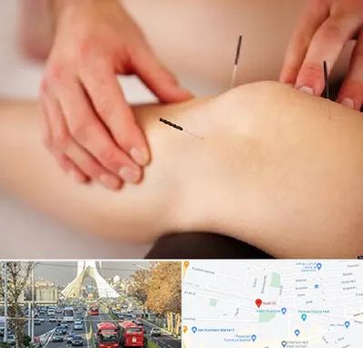 دکتر طب سوزنی برای لاغری در خیابان آزادی 