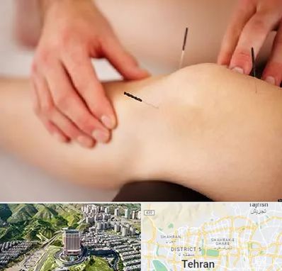 دکتر طب سوزنی برای لاغری در شمال تهران 