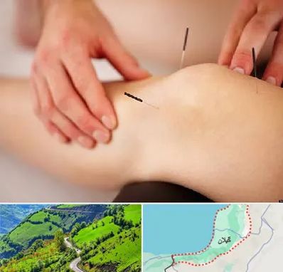 دکتر طب سوزنی برای لاغری در گیلان