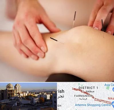 دکتر طب سوزنی برای لاغری در فرمانیه 