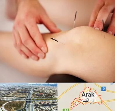 دکتر طب سوزنی برای لاغری در اراک