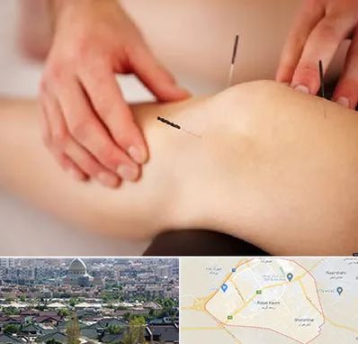 دکتر طب سوزنی برای لاغری در رباط کریم