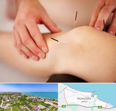 دکتر طب سوزنی برای لاغری در نوشهر