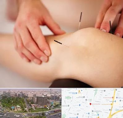 دکتر طب سوزنی برای لاغری در آیت الله کاشانی