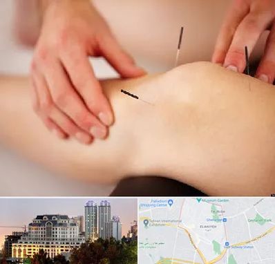 دکتر طب سوزنی برای لاغری در فرشته 