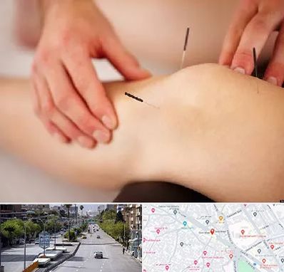 دکتر طب سوزنی برای لاغری در خیابان زند شیراز 