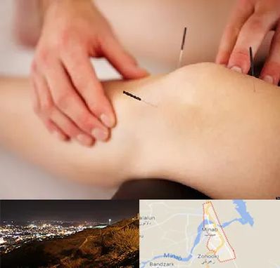 دکتر طب سوزنی برای لاغری در میناب