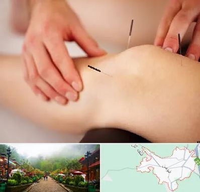 دکتر طب سوزنی برای لاغری در فومن
