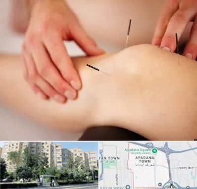 دکتر طب سوزنی برای لاغری در آپادانا