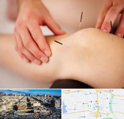 دکتر طب سوزنی برای لاغری در شهرک راه آهن 