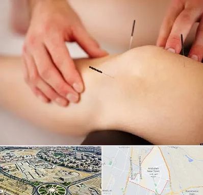 دکتر طب سوزنی برای لاغری در اندیشه