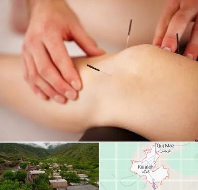 دکتر طب سوزنی برای لاغری در کلاله