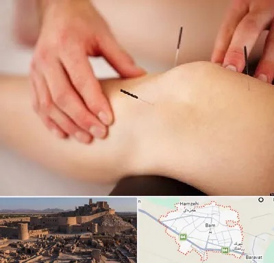 دکتر طب سوزنی برای لاغری در بم