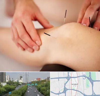 دکتر طب سوزنی برای لاغری در توانیر