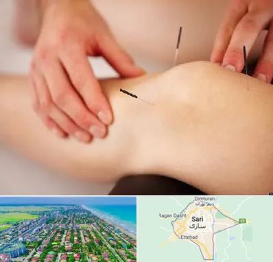 دکتر طب سوزنی برای لاغری در ساری