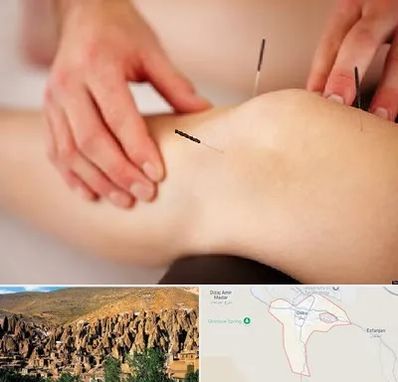 دکتر طب سوزنی برای لاغری در اسکو