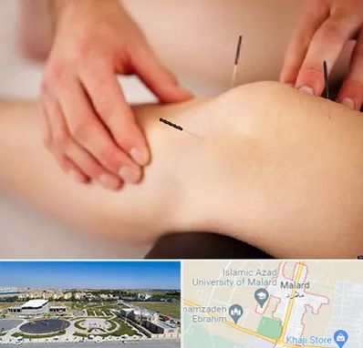 دکتر طب سوزنی برای لاغری در ملارد