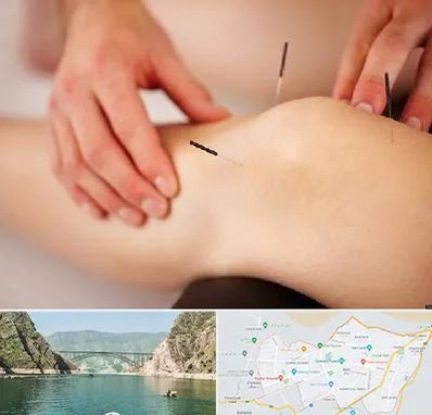 دکتر طب سوزنی برای لاغری در ایلام