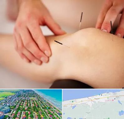 دکتر طب سوزنی برای لاغری در فریدونکنار