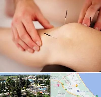 دکتر طب سوزنی برای لاغری در رودسر