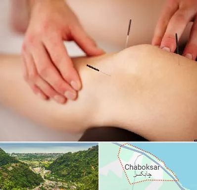 دکتر طب سوزنی برای لاغری در چابکسر