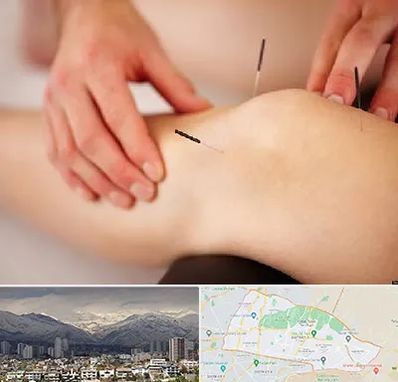 دکتر طب سوزنی برای لاغری در منطقه 4 تهران 