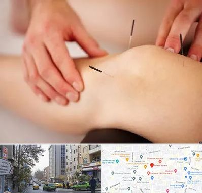 دکتر طب سوزنی برای لاغری در فاطمی 