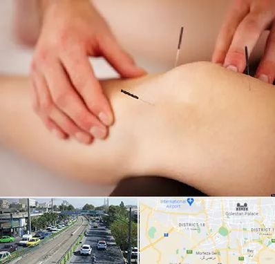 دکتر طب سوزنی برای لاغری در جنوب تهران 