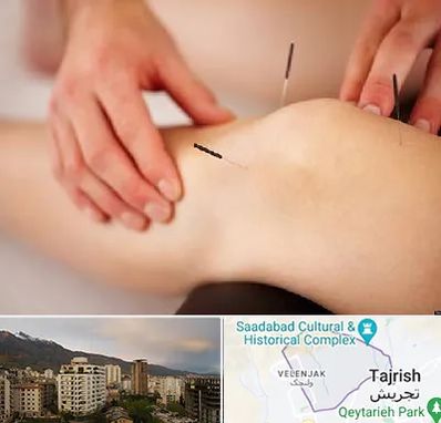 دکتر طب سوزنی برای لاغری در زعفرانیه 