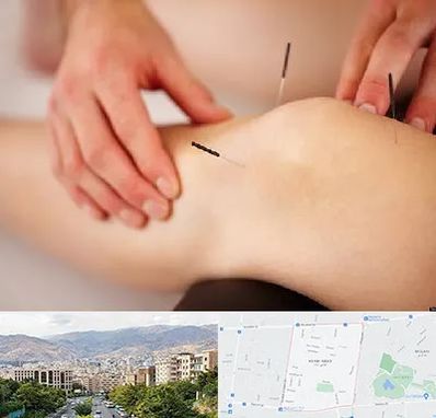 دکتر طب سوزنی برای لاغری در خانی آباد
