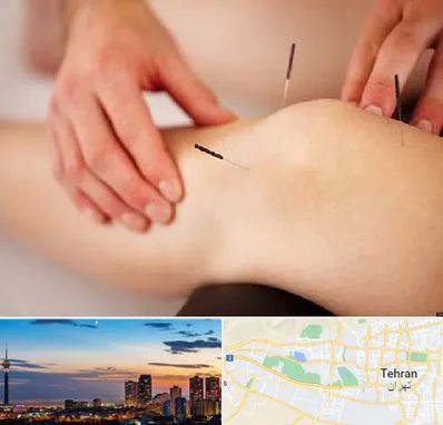 دکتر طب سوزنی برای لاغری در غرب تهران 