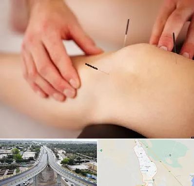 دکتر طب سوزنی برای لاغری در اندیمشک