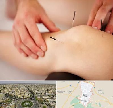 دکتر طب سوزنی برای لاغری در قزوین