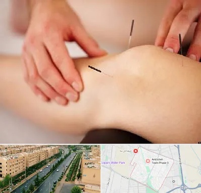 دکتر طب سوزنی برای لاغری در فاز سه اندیشه