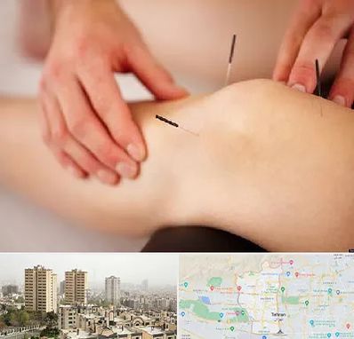 دکتر طب سوزنی برای لاغری در منطقه 5 تهران 