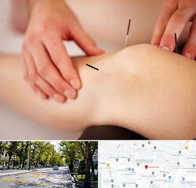 دکتر طب سوزنی برای لاغری در میرداماد 