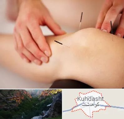 دکتر طب سوزنی برای لاغری در کوهدشت