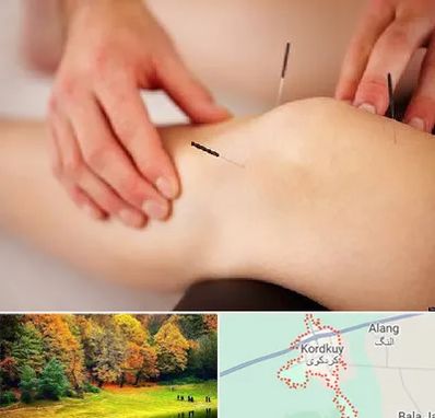 دکتر طب سوزنی برای لاغری در کردکوی