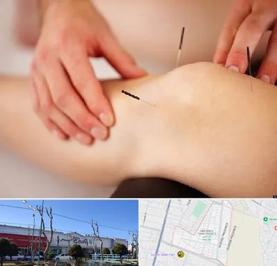 دکتر طب سوزنی برای لاغری در فاز دو اندیشه