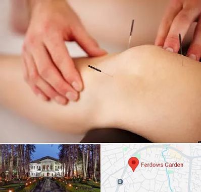 دکتر طب سوزنی برای لاغری در باغ فردوس