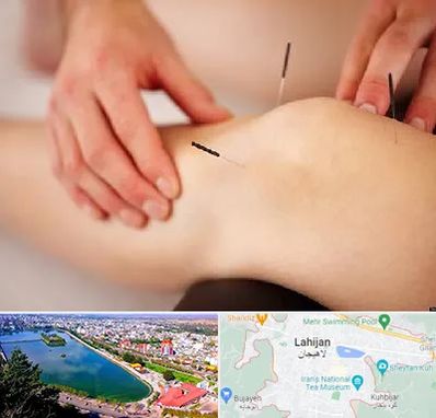 دکتر طب سوزنی برای لاغری در لاهیجان