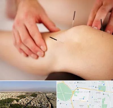 دکتر طب سوزنی برای لاغری در نازی آباد
