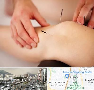 دکتر طب سوزنی برای لاغری در پونک 