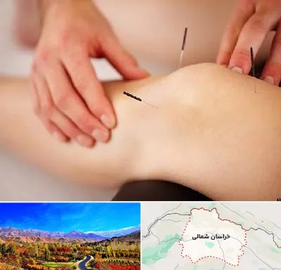 دکتر طب سوزنی برای لاغری در خراسان شمالی