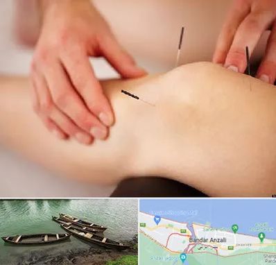 دکتر طب سوزنی برای لاغری در بندر انزلی