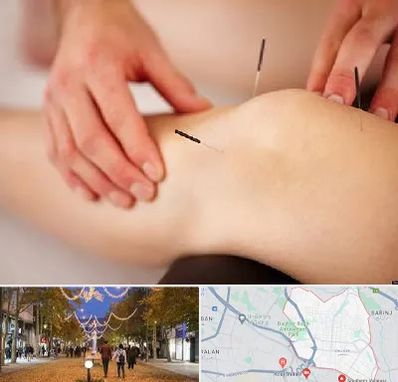 دکتر طب سوزنی برای لاغری در ولیعصر ارومیه 