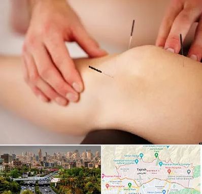 دکتر طب سوزنی برای لاغری در منطقه 1 تهران 